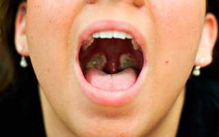 Чистка миндалин от пробок