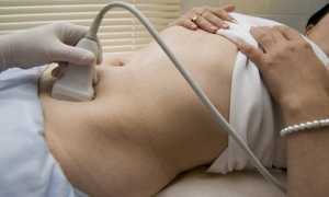 Мультифолликулярные яичники