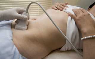 Мультифолликулярные яичники