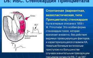 Малоизученная, но опасная вазоспастическая стенокардия