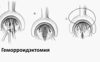 Основные варианты хирургического лечения геморроя и другие методы избавления от интимной проблемы