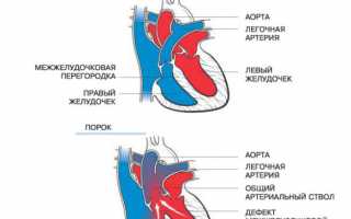 Врожденный порок общий артериальный ствол: шансы ребенка, методы спасения