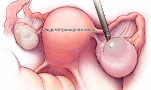 Эндометриоидная киста яичника