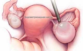Эндометриоидная киста яичника