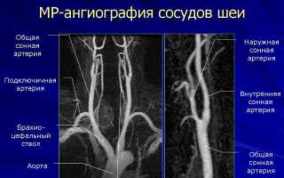 Выпячивание или аневризма сонной артерии: стоит ли переживать?