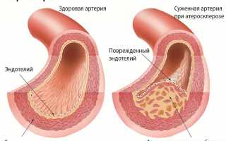 Как связаны атеросклероз и холестерин