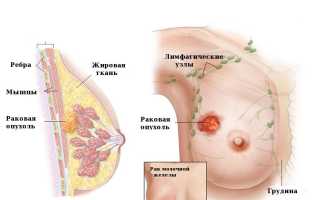 Диета при раке молочной железы