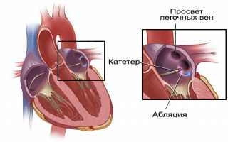 Почему возникает аритмия после операции