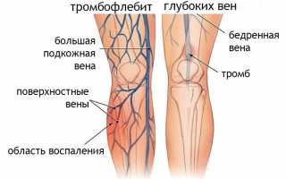 Что представляет собой тромбофлебит поверхностных вен, его диагностика и лечение