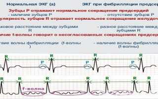 Распространенные и редкие формы мерцательной аритмии