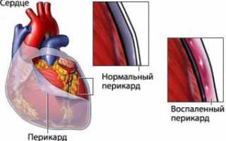 Почему болит сердце при глубоком вдохе