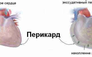 Насколько опасен экссудативный перикардит для взрослых и детей, методы его лечения