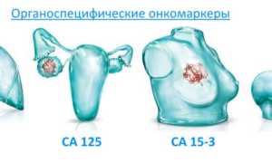 Норма СА-125 при кисте яичника