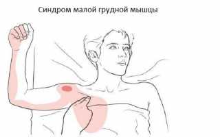 Как проявляется синдром малой грудной мышцы, его лечение