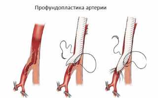 Как выполняют операцию на бедренной артерии, восстановление после