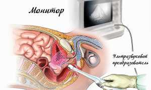 Трансректальное УЗИ предстательной железы