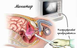 Трансректальное УЗИ предстательной железы