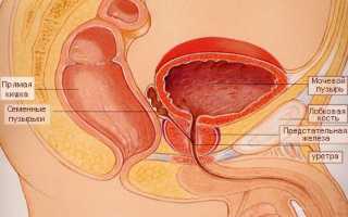 Прогнозы при раке простаты 4 степени