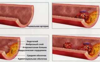 Почему развивается и как лечится облитерирующий атеросклероз сосудов нижних конечностей