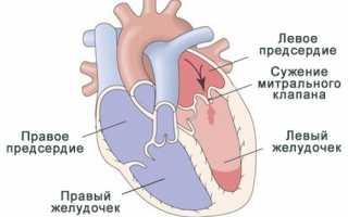 Выявлен митральный порок сердца: причины его появления, симптомы, лечение и профилактика