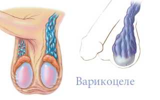 Последствия варикоцеле