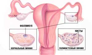 Овуляция при поликистозе