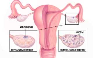 Овуляция при поликистозе