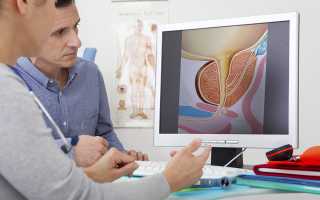 Признаки простатита и аденомы простаты