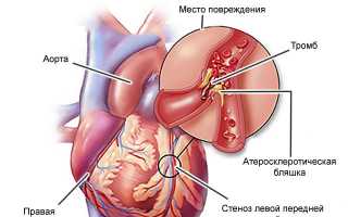 Системный или генерализованный атеросклероз