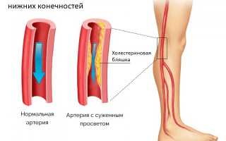 Опасные осложнения атеросклероза: с чем можно столкнуться?