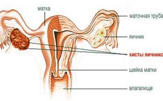 Народные средства от кисты яичника
