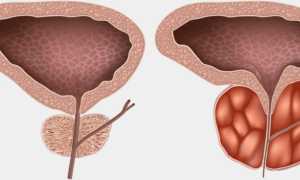 Профилактика простатита народными средствами