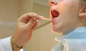 Налет на гландах