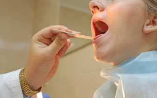 Налет на гландах