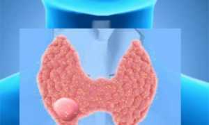 Как избавиться от узлов на щитовидке без операции?