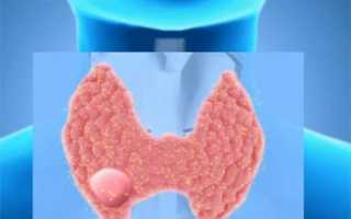 Как избавиться от узлов на щитовидке без операции?