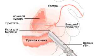 Как проводится УЗИ предстательной железы