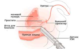 Как проводится УЗИ предстательной железы