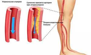 Диабетическая ангиопатия