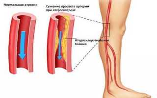 Диабетическая ангиопатия