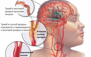 Поражение головного мозга из-за нарушения кровообращения — цереброваскулярная недостаточность: чем грозит патология?