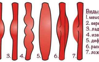 Причины появления аневризмы бедренной артерии и методы избавления от нее