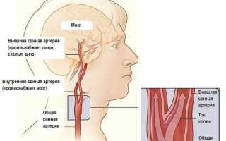 Как диагностируется и лечится гипоплазия сонной артерии