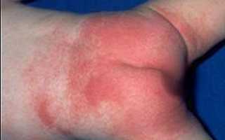 Почему возникает пеленочный дерматит: фото, методы лечения и профилактики