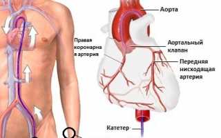 Зачем и кому нужна коронарография сосудов сердца