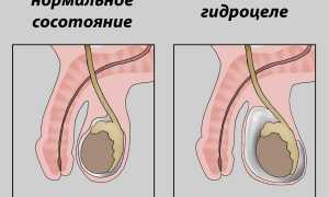 Операция при гидроцеле