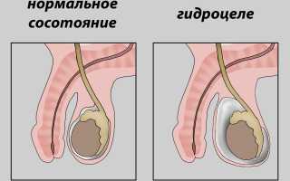 Операция при гидроцеле
