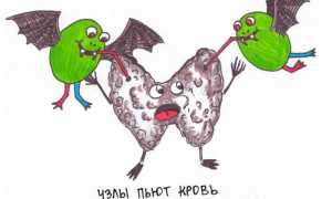 Узел щитовидной железы с кровотоком