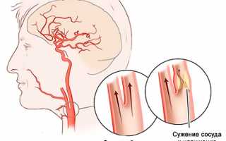 Причины сужения сосудов головного мозга, чем нормализовать состояние