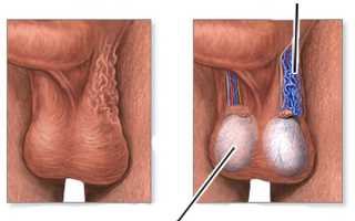 Одна из самых безопасных и результативных при варикоцеле операция Мармара